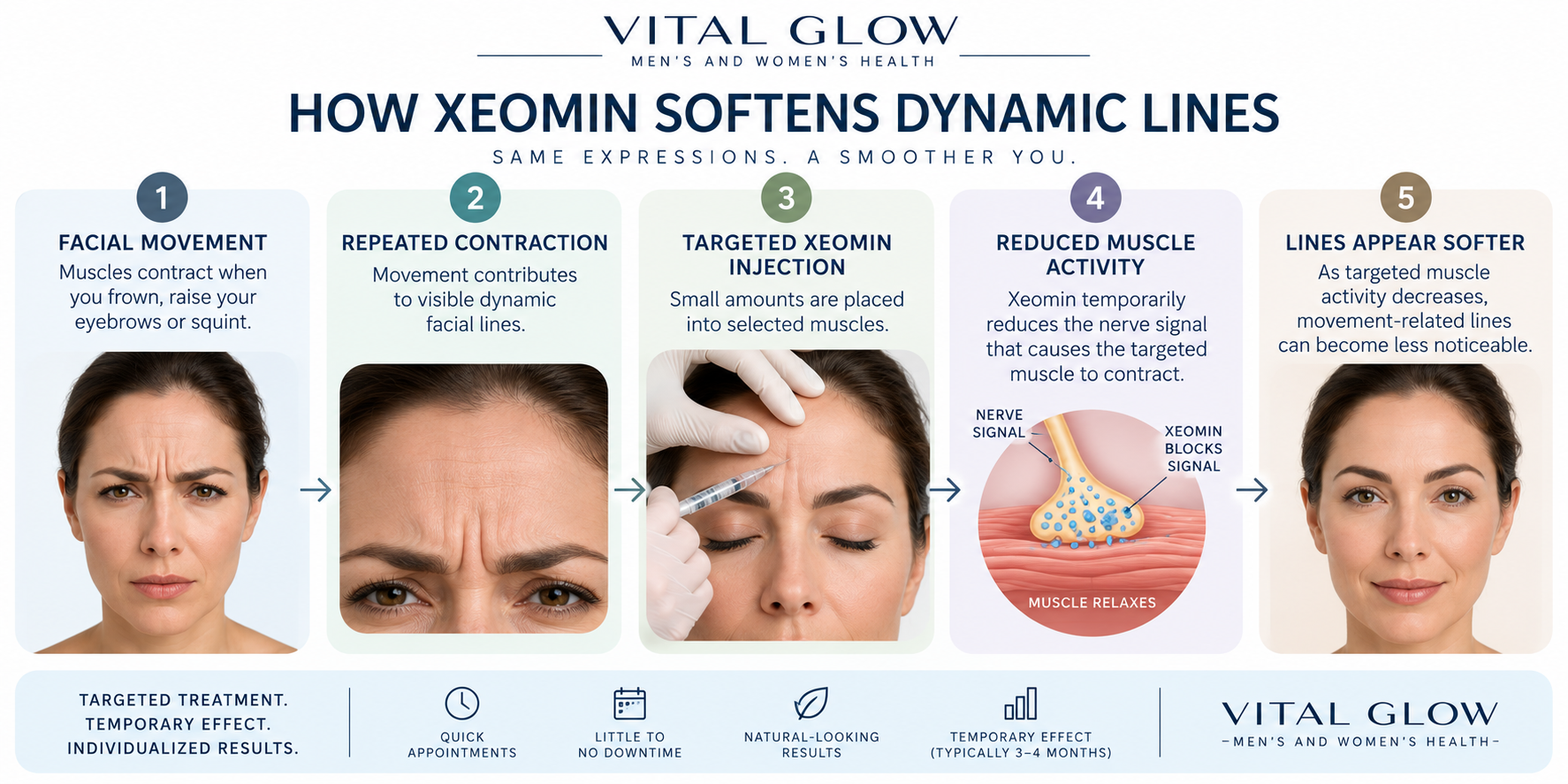How Xeomin softens dynamic facial lines by temporarily reducing targeted muscle activity