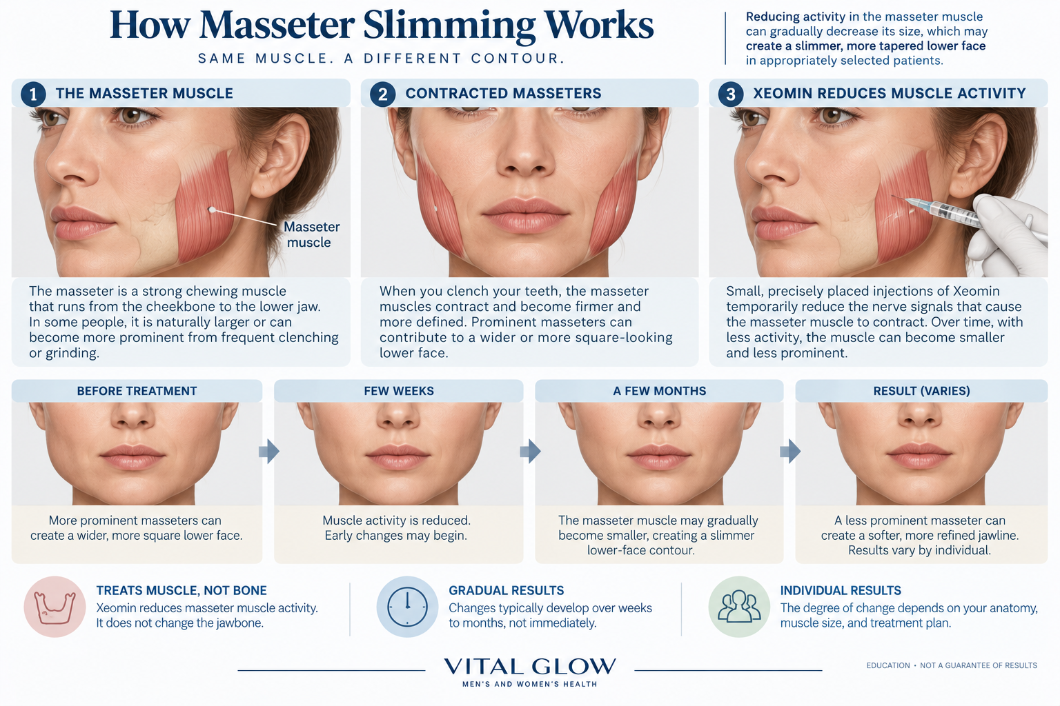 Masseter muscle anatomy and how Xeomin reduces muscle activity to gradually slim a prominent lower jaw.