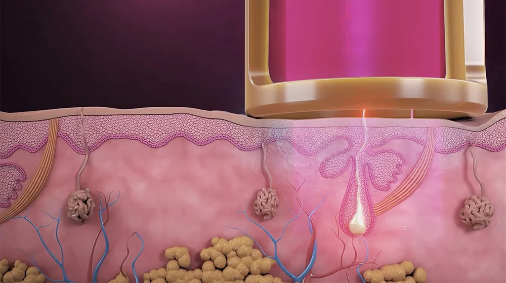 Illustration of Candela GentleMax Pro Plus® laser targeting a hair follicle beneath the skin, demonstrating dual-wavelength laser hair removal technology.