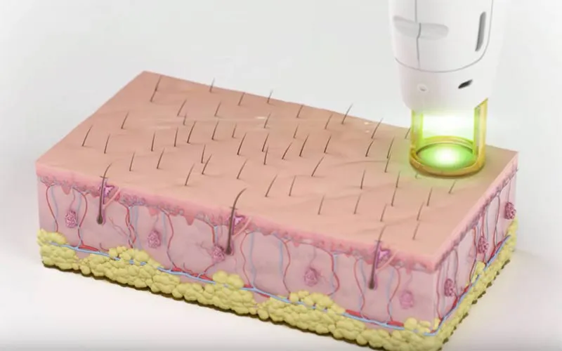 Illustration of Candela GentleMax Pro Plus® laser technology targeting hair follicles beneath the skin for laser hair removal at Vital Glow in Columbia, SC.