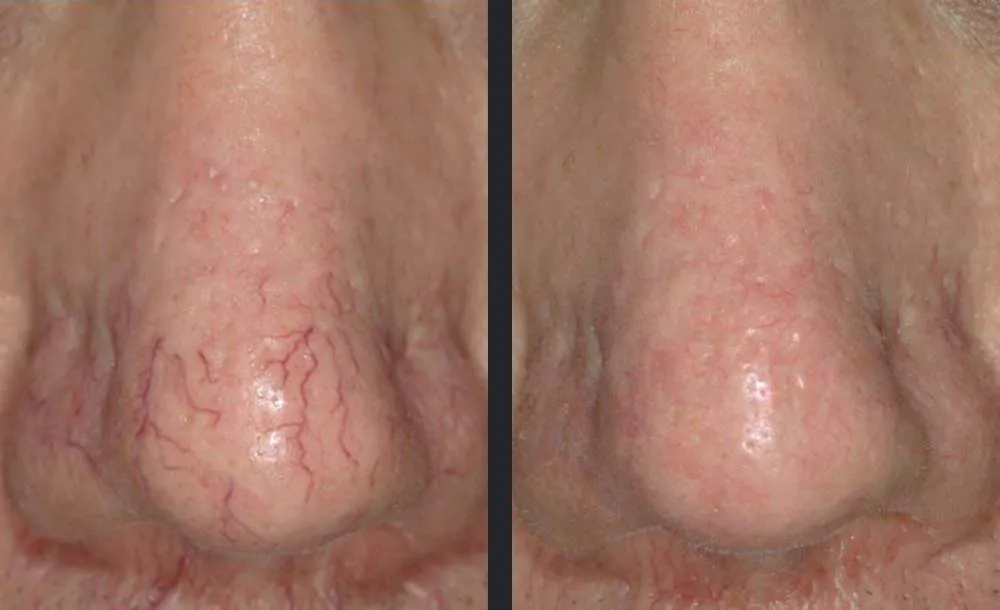 Before-and-after photos showing reduced visible spider veins and broken capillaries on the nose following laser vascular treatment with Candela GentleMax Pro Plus®.