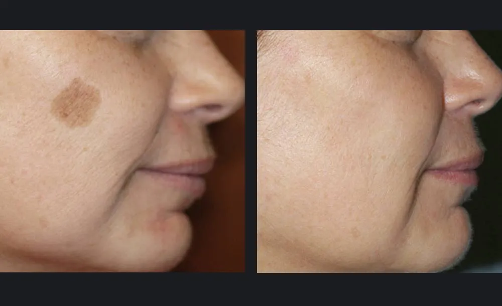 Before-and-after photos showing a reduction in a prominent brown sun spot on a woman's cheek and a more even-looking skin tone following laser pigmentation treatment.