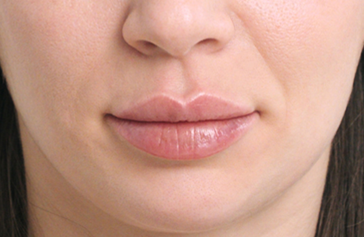 Close-up of a woman's lower face following chin filler treatment, highlighting natural-looking lips, chin definition, and balanced facial contours.