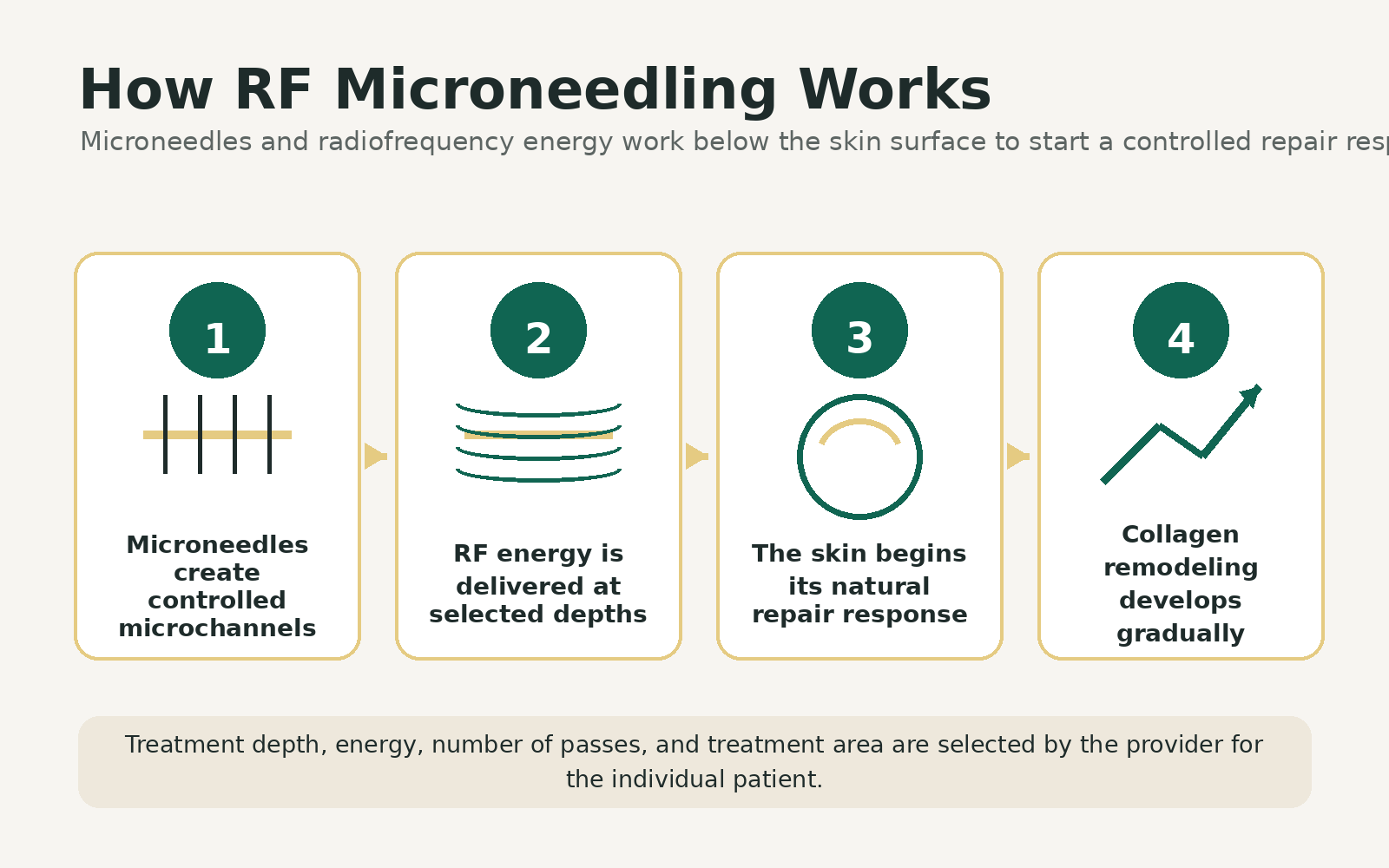 Four-step infographic explaining RF microneedling, from controlled microneedle insertion and radiofrequency energy delivery to the skin's natural healing response and gradual collagen remodeling.