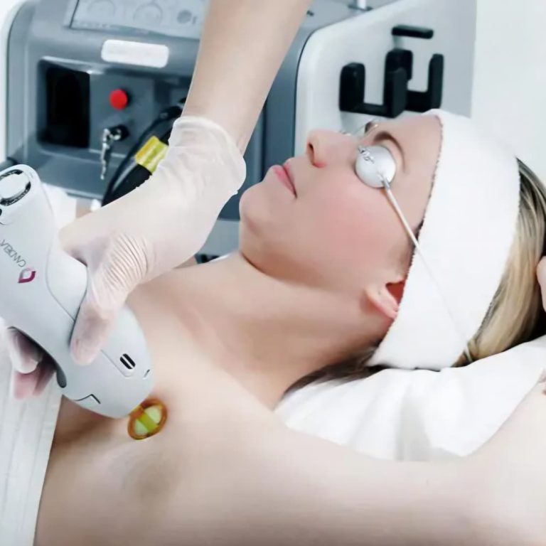 Woman wearing protective eyewear receiving laser hair removal treatment on her underarm from a medical professional using a Candela laser device.