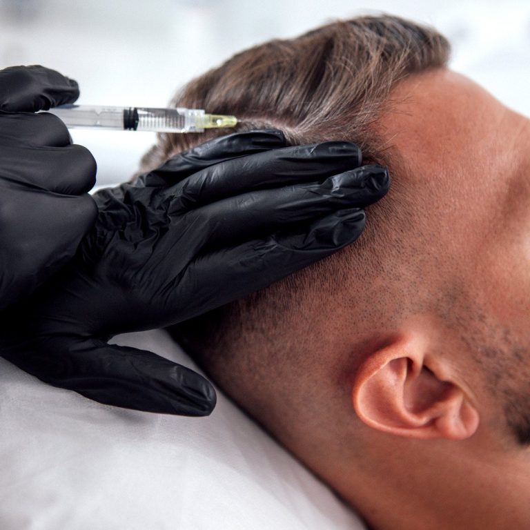 Close-up of a medical professional wearing black gloves administering an injection along a man's thinning hairline during a non-surgical hair restoration treatment.